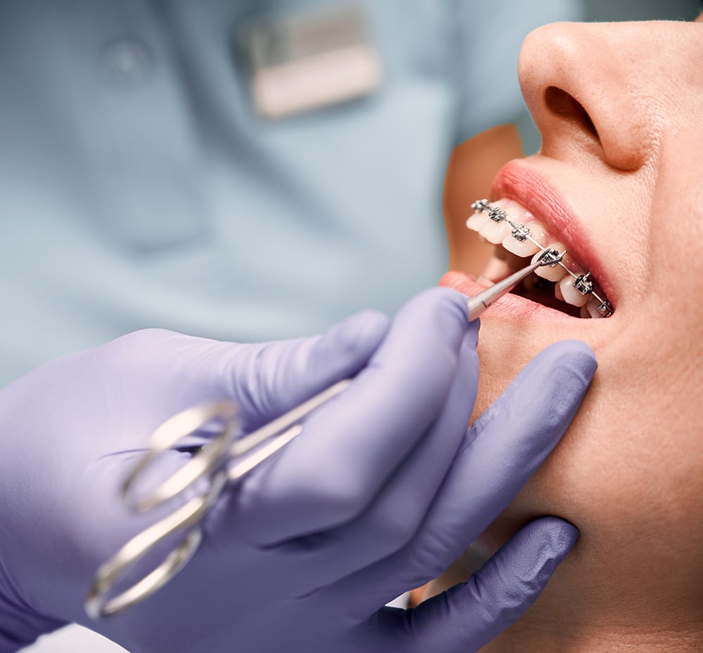 Orthodontist hand placing braces on woman teeth.
