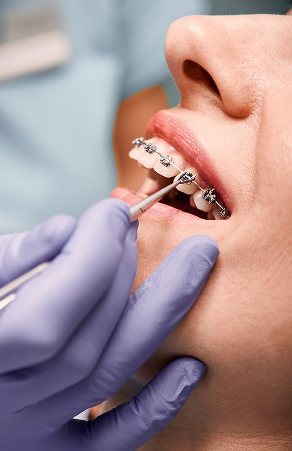 Orthodontist hand placing braces on woman teeth.